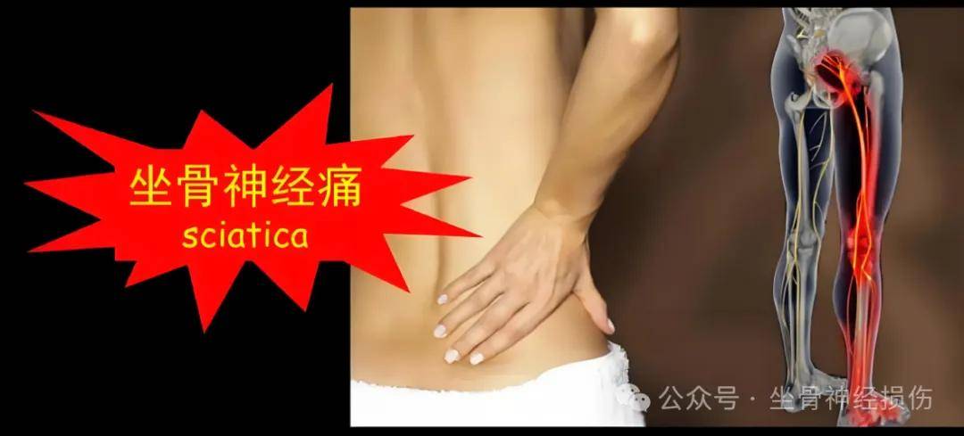 揭秘坐骨神经痛的多样“痛点”