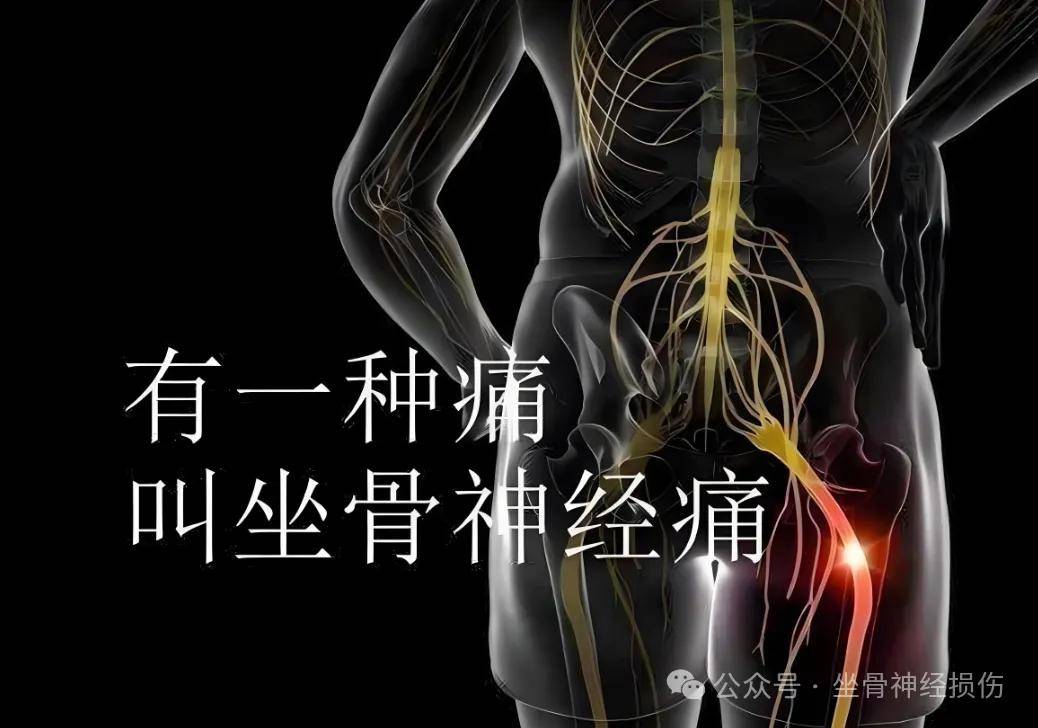 揭秘坐骨神经痛的多样“痛点”
